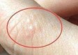 脚上起小水泡还很痒是怎么回事？一文读懂原因与应对方法